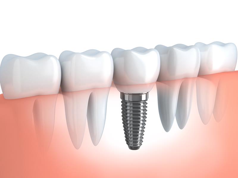 Dental Implants  Victoria, TX 