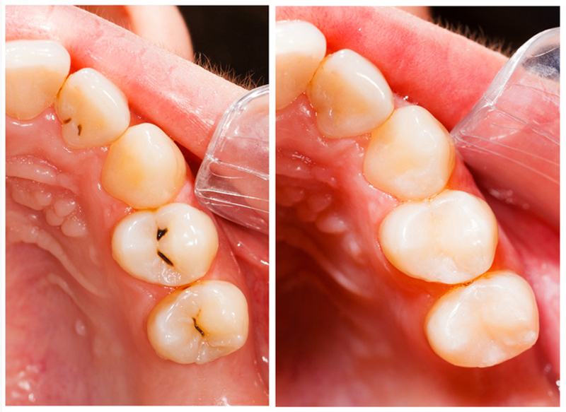 Fillings  Victoria, TX 