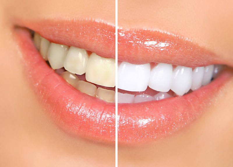 Teeth Whitening  Victoria, TX 