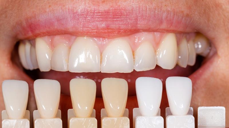 Veneers  Victoria, TX 